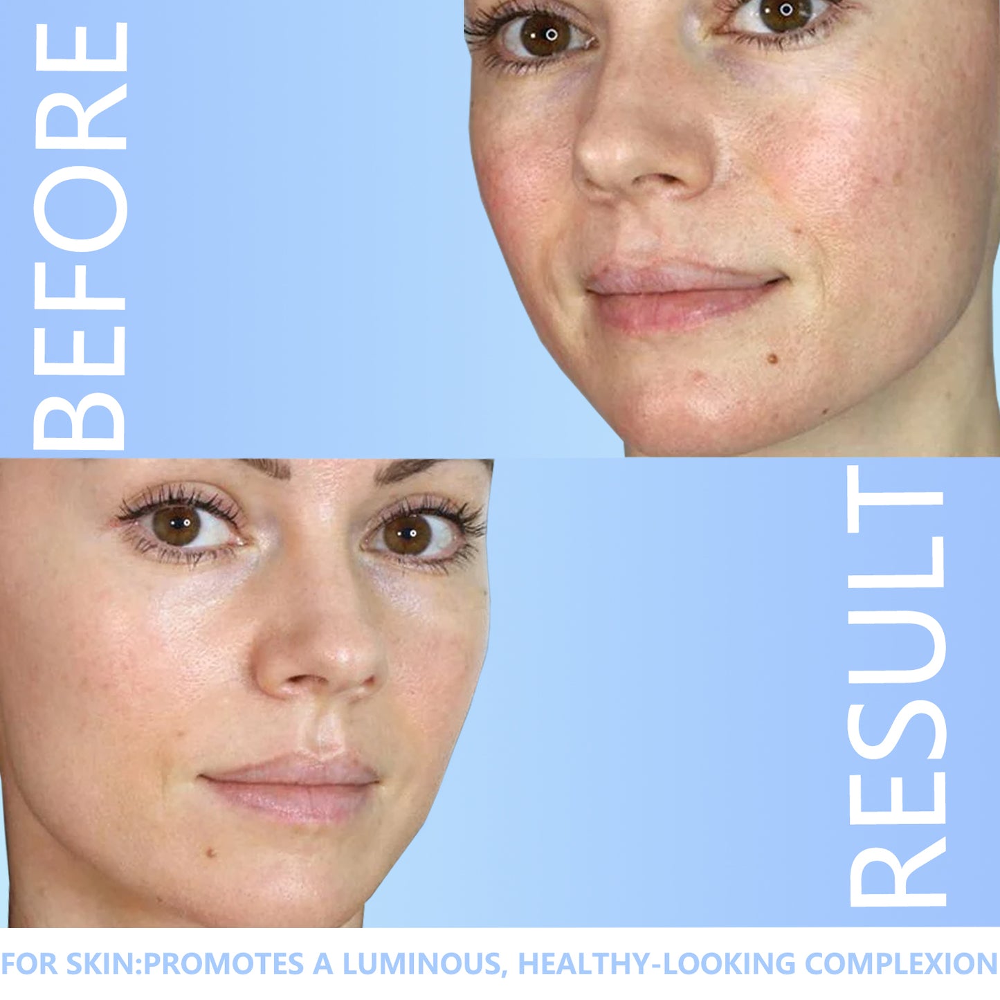 Derma Roller 540 Titanium Microneedling Roller