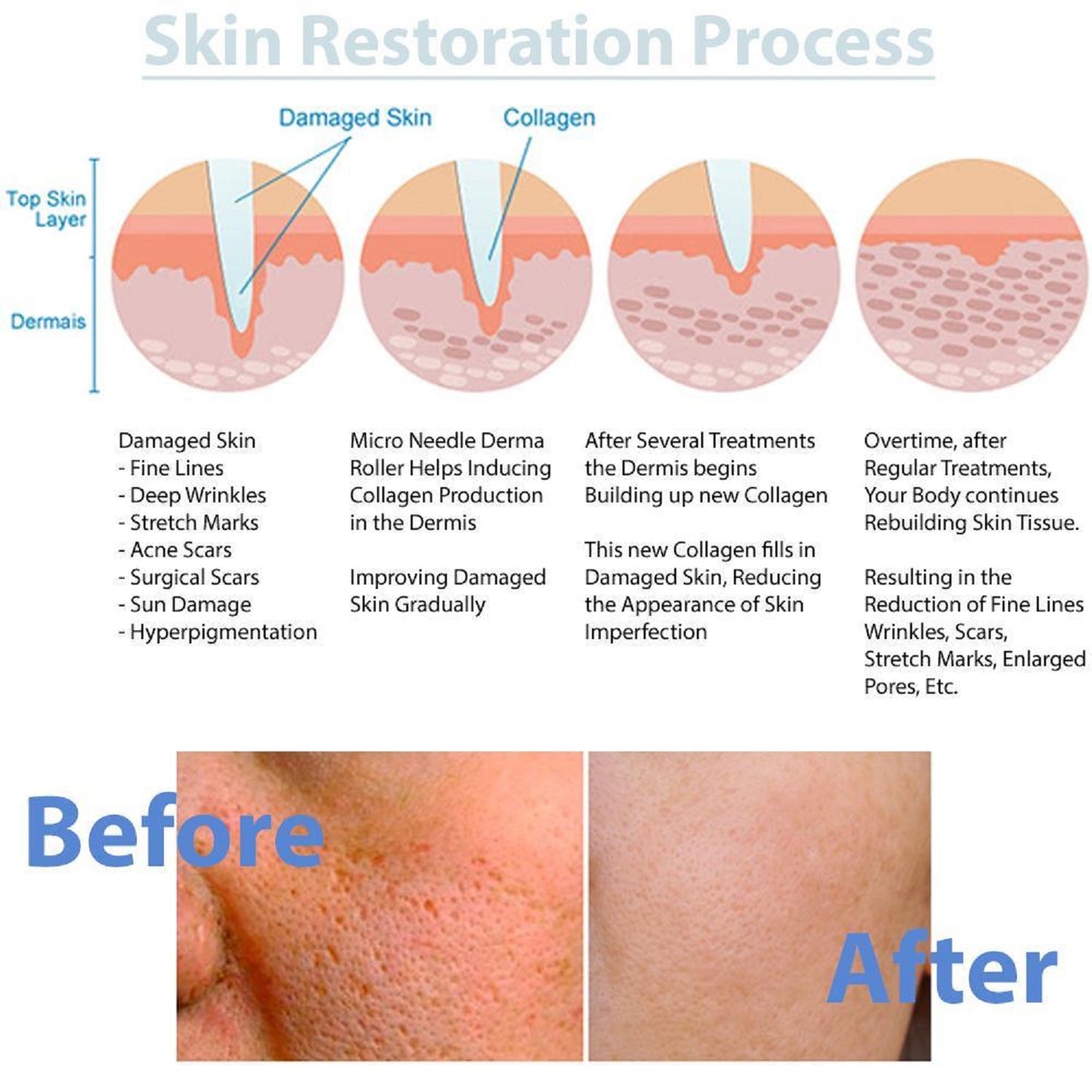 Derma Roller 1200 Titanium Microneedling Roller 0.5mm